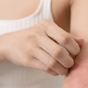 Mes de la Atopia: qué es y por qué es clave concientizar sobre la dermatitis atópica