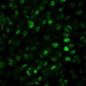 Científicos del CONICET logran frenar un agresivo tumor cerebral en pruebas de laboratorio