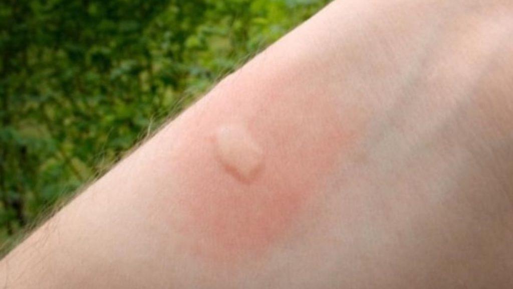 Chikungunya en Argentina: Salta supera los 150 casos y detectan el primero en Catamarca Chikungunya en Argentina: Salta supera los 150 casos y detectan el primero en Catamarca